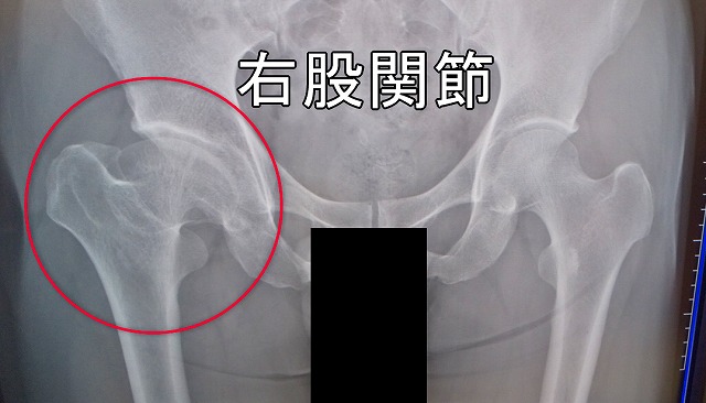両股関節のレントゲン写真